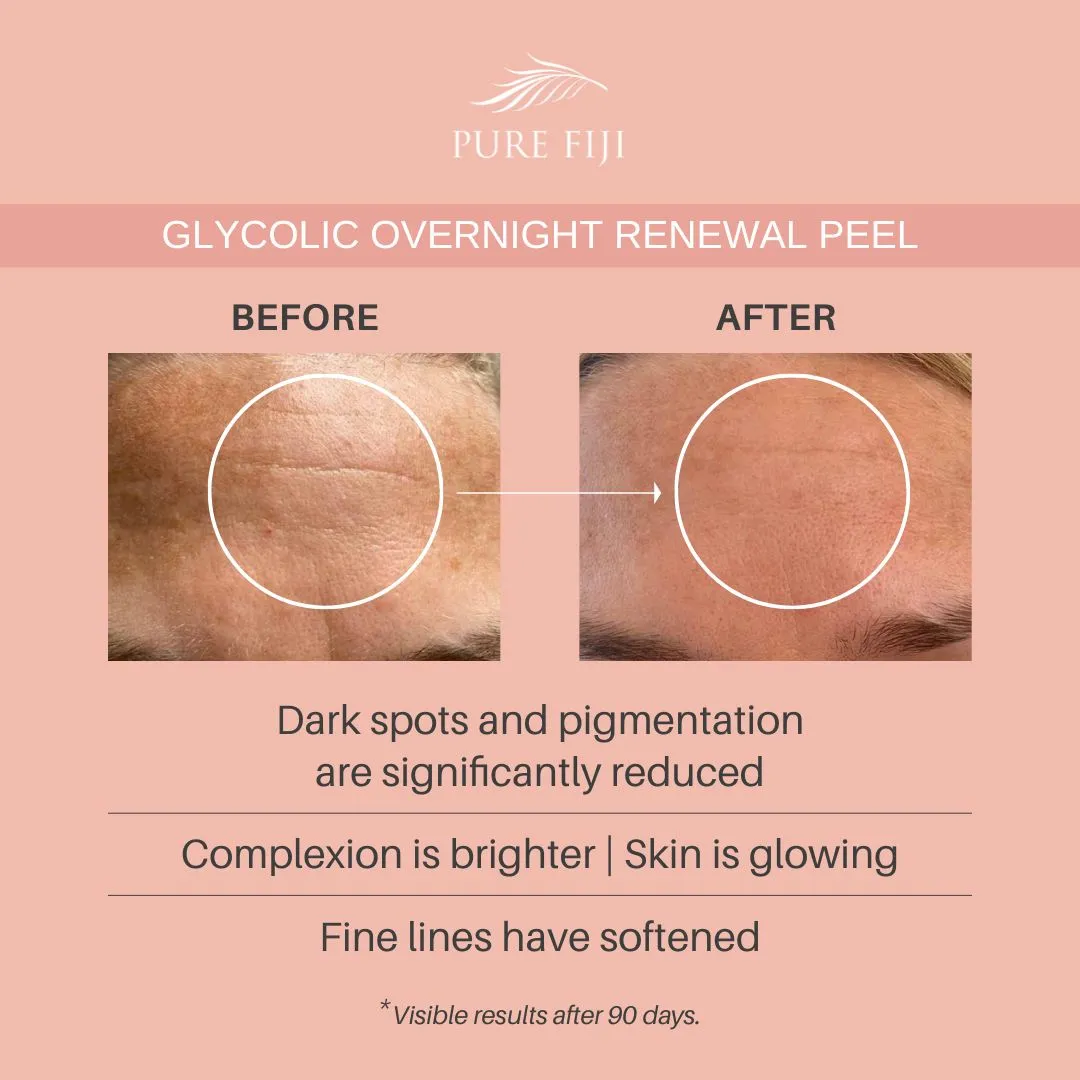 Glycolic Overnight Renewal Peel with Mandelic   Niacinamide (1oz/30ml)
