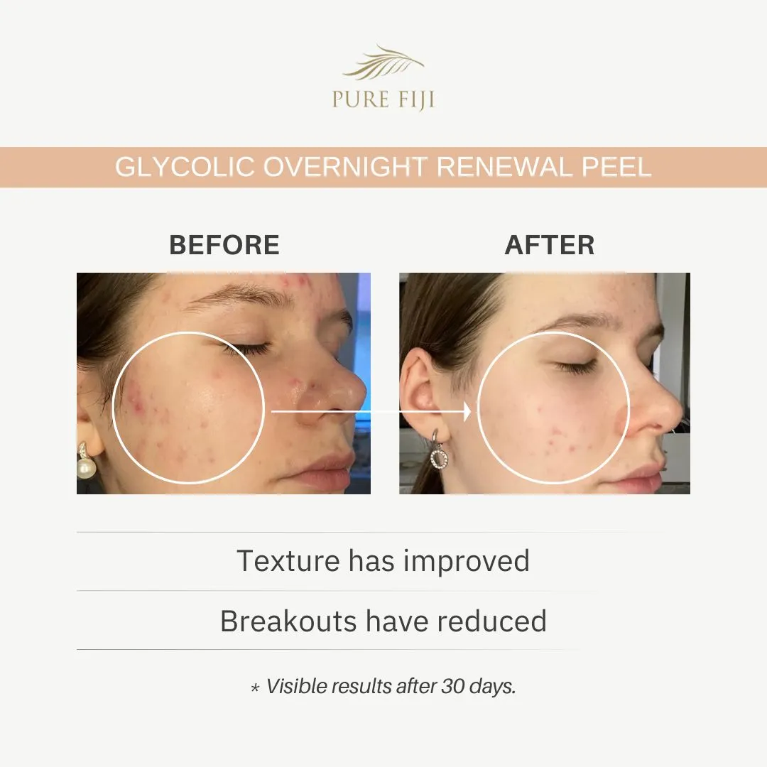 Glycolic Overnight Renewal Peel with Mandelic   Niacinamide (1oz/30ml)